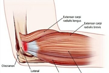 Elbow Pain Picture 1