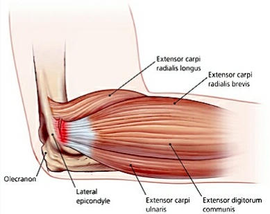 Elbow Pain Picture 1