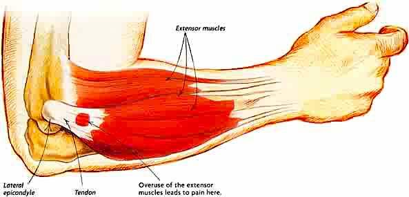 Elbow Pain Picture 2