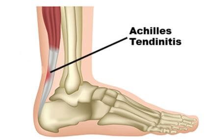 Achilles tendinitis