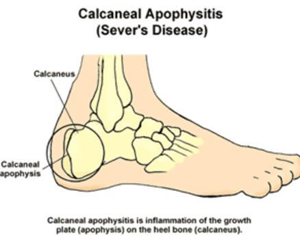 Calcaneal Apophysitis