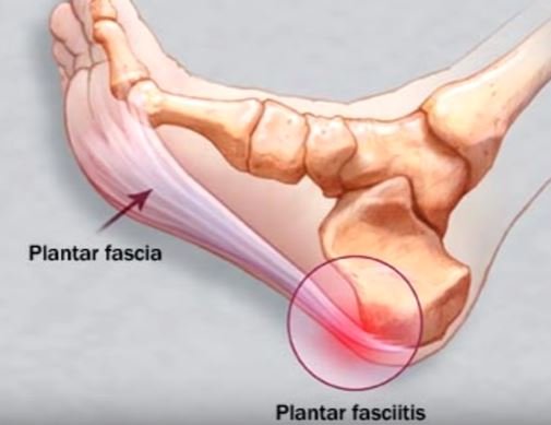 heel pain plantar fascitis