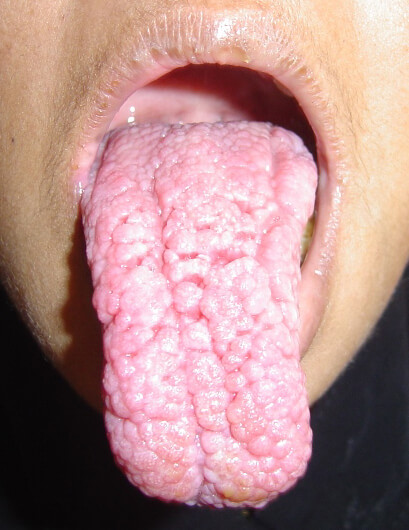 Fissured-Tongue-5