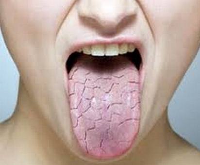 Fissured-Tongue-photo