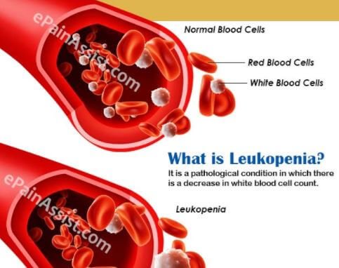 Leukopenia - Definition, Causes, Treatment, Symptoms, Pictures