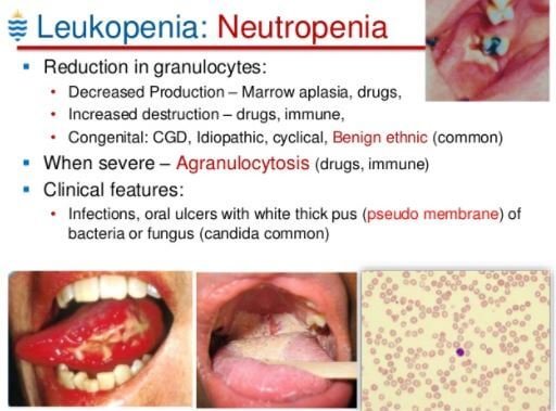 Leukopenia Neutropenia