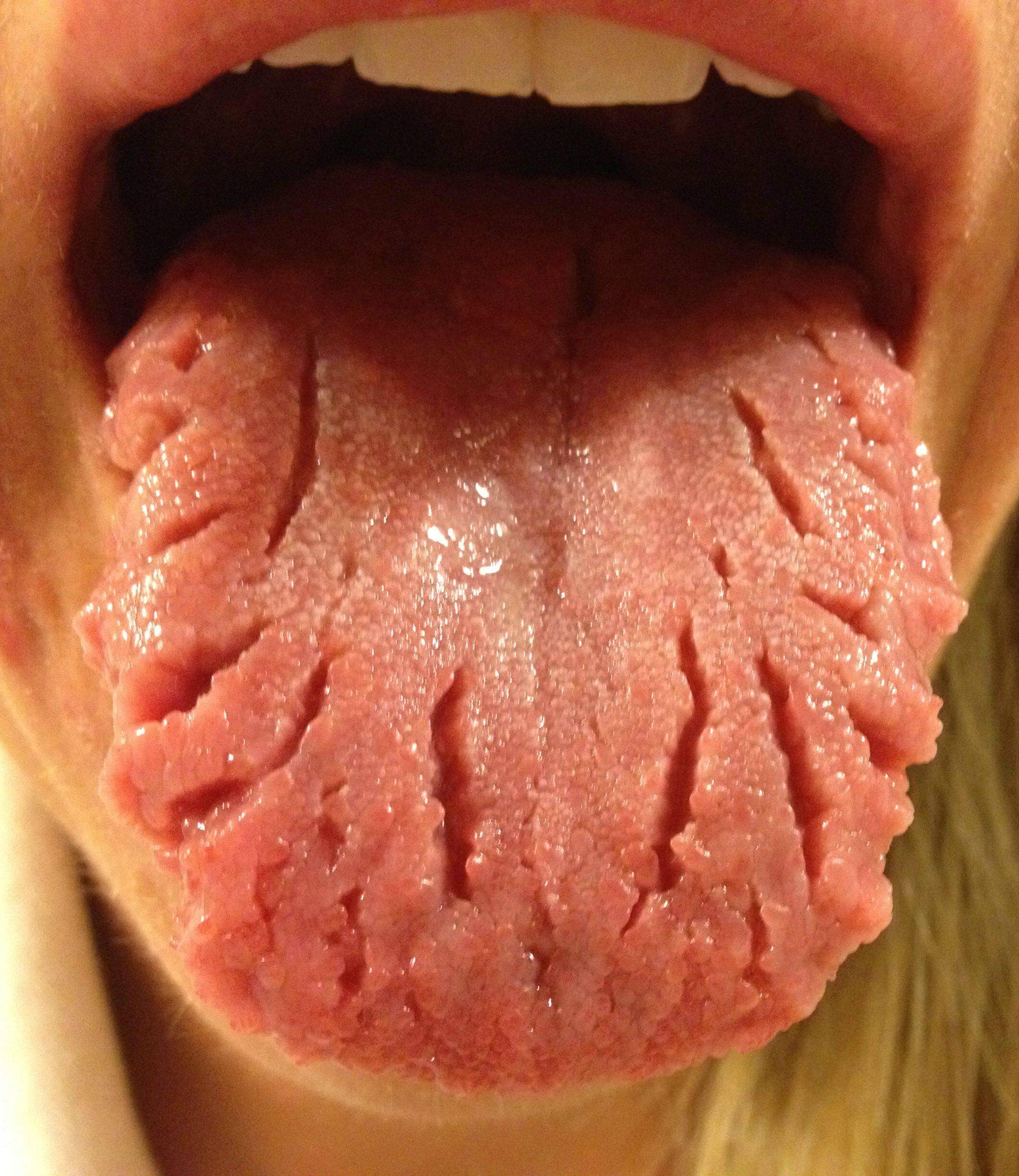 fissured tongue pictures