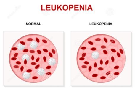 leukopenia