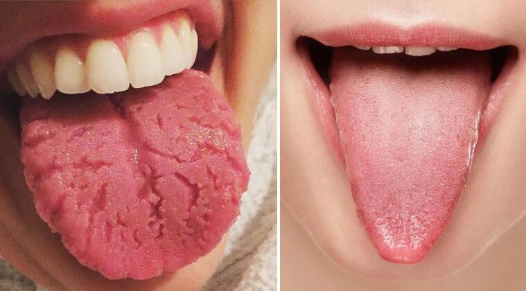 tongue-health vs Fissured Tongue
