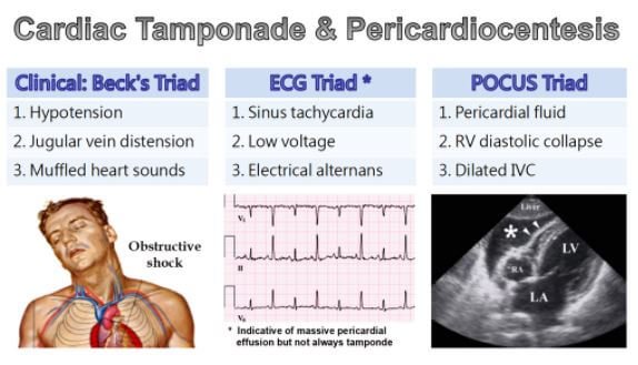 Cardiac tamponade becks ecg pocus triad