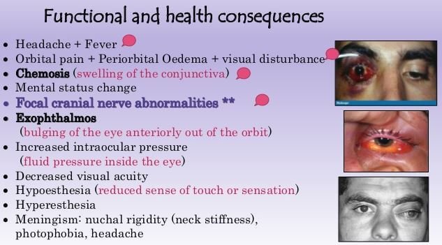 Cavernous Sinus Thrombosis clinical importance