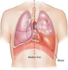 Hemothorax