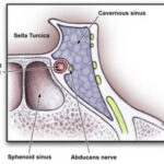 Cavernous Sinus Thrombosis