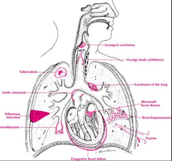 hemoptysis causes