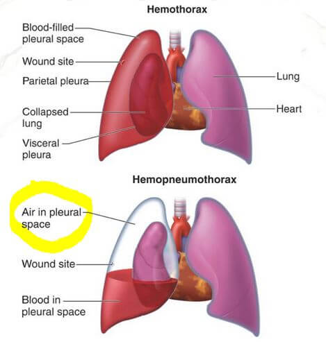hemothorax and hemopneumothorax