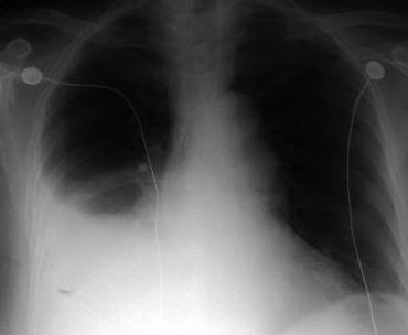 hemothorax x ray
