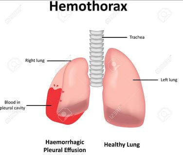 hemothorax