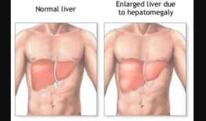 Hepatomegaly Enlarged Liver