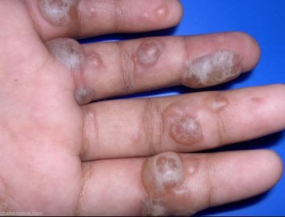 Is Your Spongiotic Dermatitis Hiding A Lupus Diagnosis - dfr1oo7
