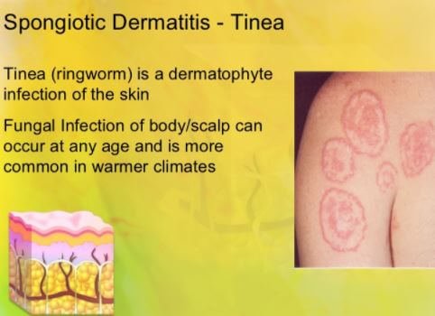 Spongiotic Dermatitis