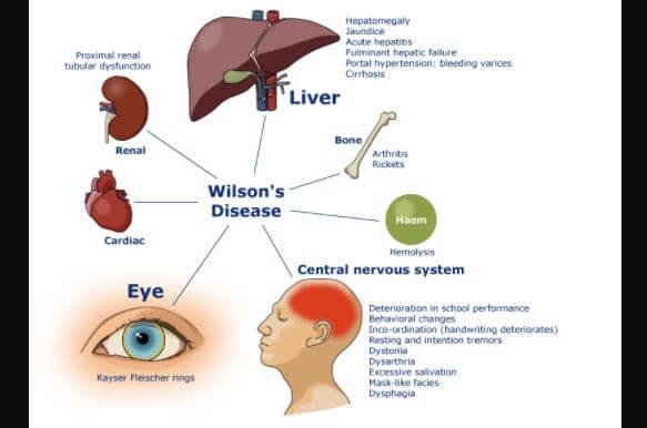 Wilson Disease