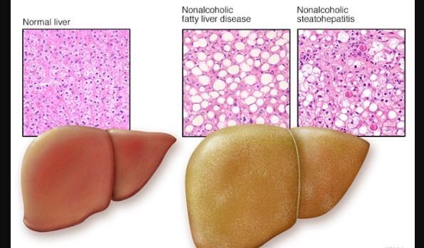 non alcoholic fatty liver disease