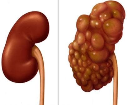 Chronic Kidney Disease