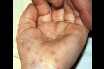 Rocky mountain spotted fever rash
