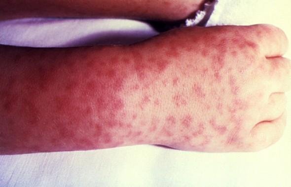 Rocky Mountain Spotted Fever