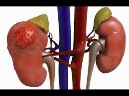 Chronic Kidney Disease Stage 3