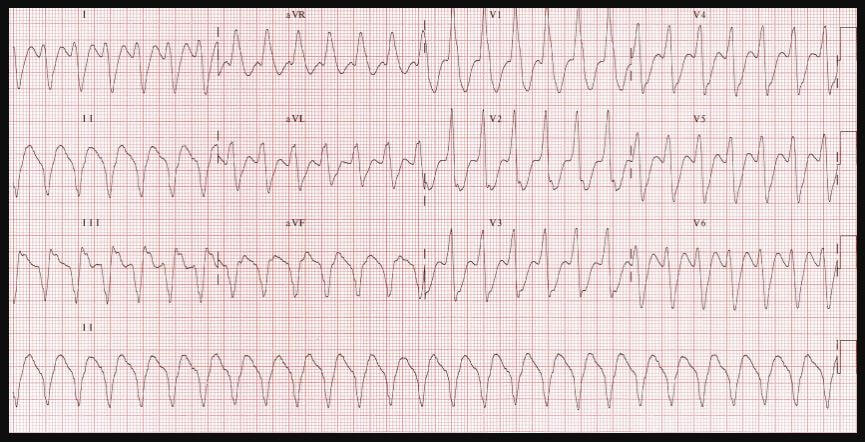 monomorphic ventricular tachycardia ECG Electrocardiogram