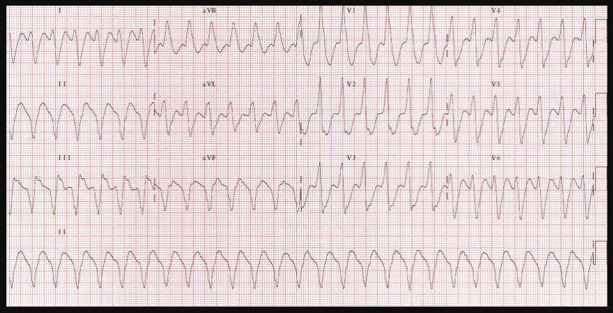 monomorphic ventricular tachycardia ECG Electrocardiogram