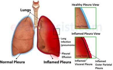 Pleuritis pleurisy