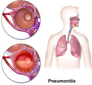 Pneumonitis