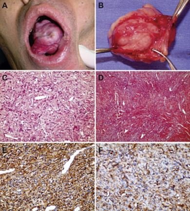 Solitary fibrous tumor