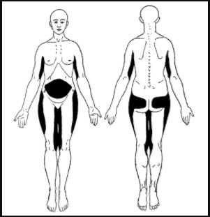 Dercum's Disease 3