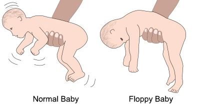 Floppy Baby Syndrome