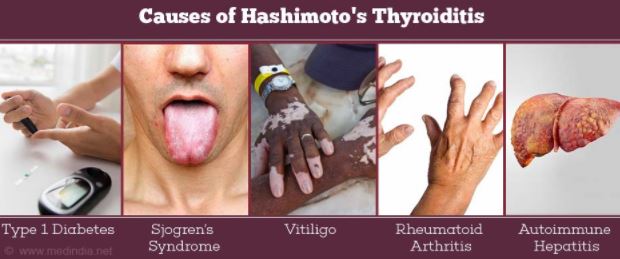 Hashimotos thyroiditis