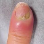 Infected Hangnail