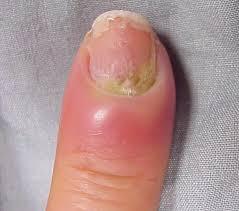 Infected hangnail images
