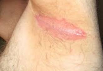 Armpit Rash