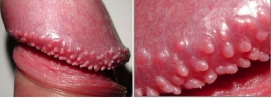 Pearly Penile Papules