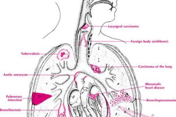 Pink Frothy Sputum hemoptysis causes