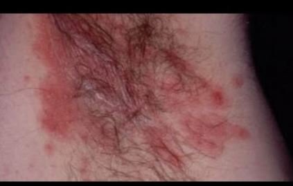 Rash under armpit