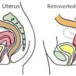 Anteverted Uterus