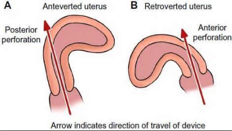 anteverted-uterus
