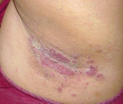 fungal-armpit-rash-pictures