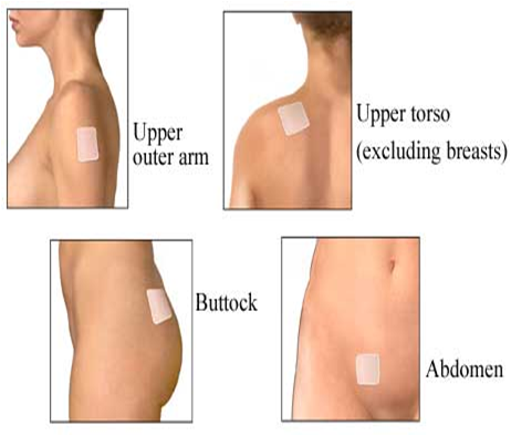 Birth Control Implant Transdermal Patch