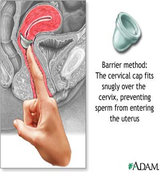 Birth Control Implant Picture 4