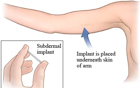 Implantation birth control subdermal implant